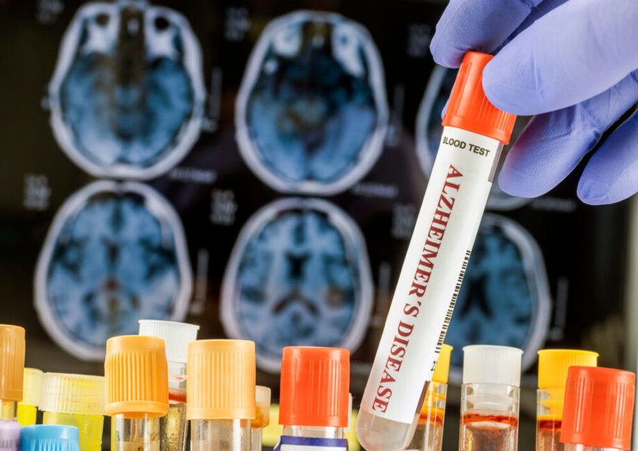 Organoidi cerebrali e ricerca sull'Alzheimer